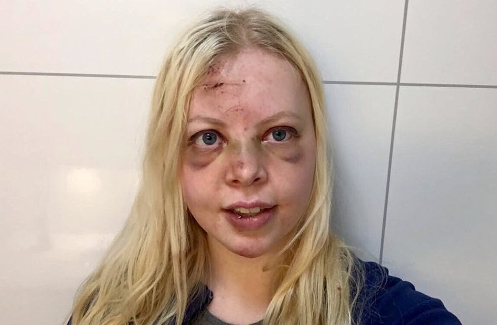 Adele Almlund blei kraftig forslått i ei fallskjermulukke fredag kveld. 19-åringen fekk hjernebløding, knekte tenner, skrubbsår, blåmerker og hevelsar. Foto: Privat.
